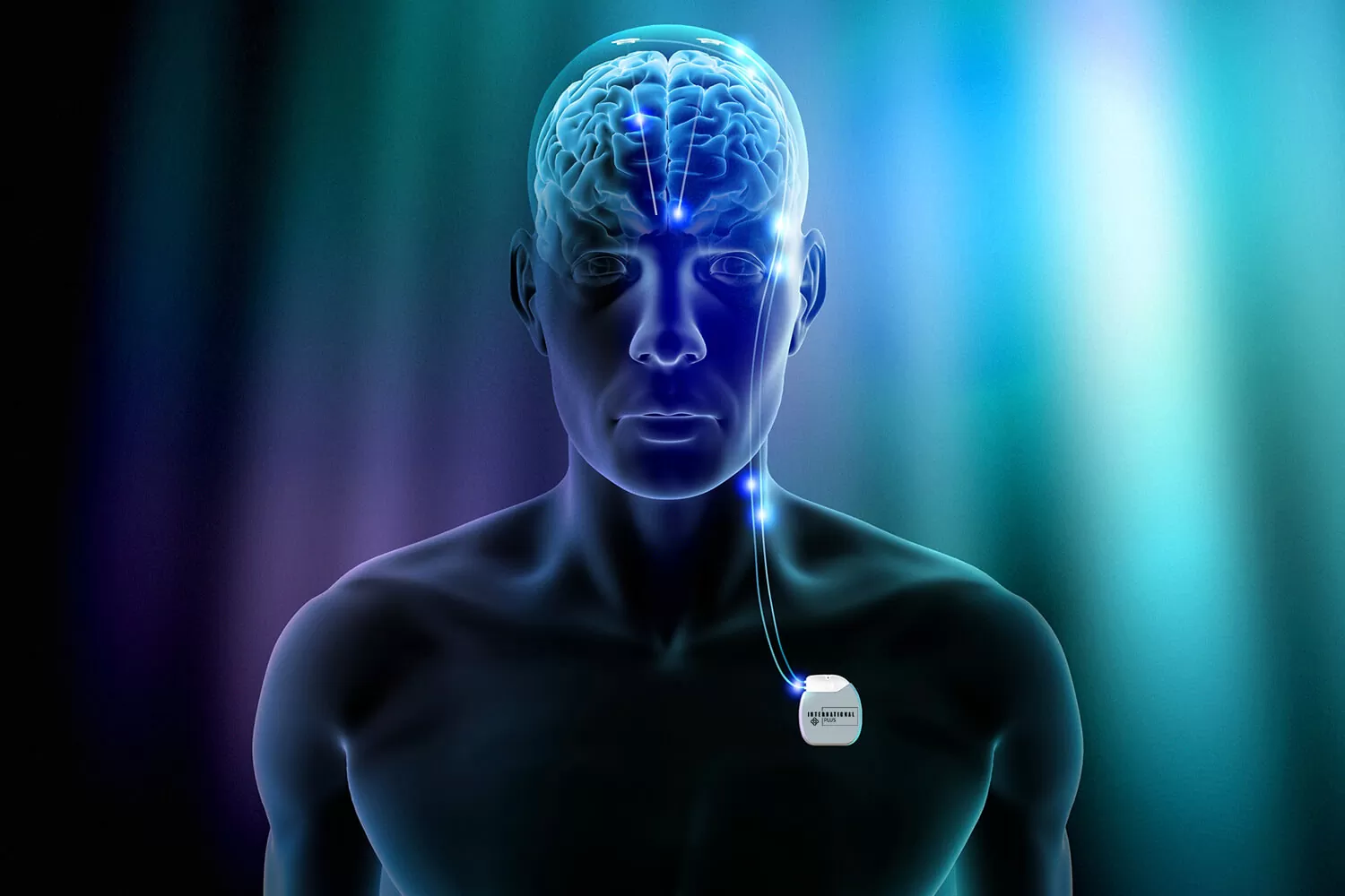 Deep Brain Stimulation